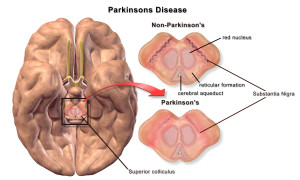 Parkinsons sykdom